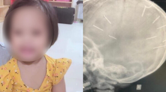 Tình hình sức khỏe của bé gái 3 tuổi ở Hà Nội hiện giờ ra sao?