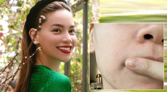 Những mỹ nhân Việt từng 'gặp nạn' khi chăm sóc da: Người bị mẩn đỏ, người thâm tím mặt mày