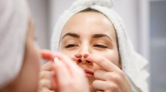 Soi các vị trí của mụn trên khuôn mặt để 'bắt bệnh' của làn da