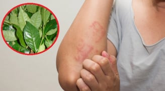 8 loại lá tắm trị mẩn ngứa, rôm sảy, mụn nhọt hiệu quả: Già - trẻ đều dùng được