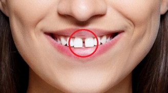 Cái răng cái tóc là góc con người: 5 kiểu răng xấu phá tướng, chặn đứng tài lộc