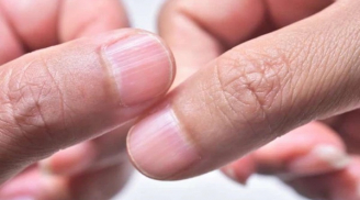 Bàn tay xuất hiện 5 dấu hiệu này chứng tỏ bệnh gan đã đi vào giai đoạn nặng, có 1 cũng phải đi khám