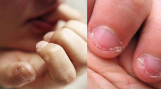 Trẻ cắn móng tay không hẳn vì thiếu chất mà do 4 nguyên nhân: Điều cuối cùng đáng lo nhất