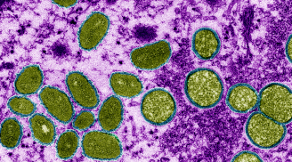 Cảnh báo mới: Tìm thấy ADN đậu mùa khỉ trong tinh dịch nam giới, phải chăng virus đã thay đổi?