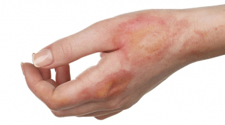 5 mẹo chữa sẹo bỏng tại nhà giúp là phẳng làn da sần sùi chỉ trong thời gian ngắn