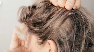 3 công thức tẩy da chết cho da đầu hiệu quả, được xem là “chìa khóa” giúp tóc chắc khỏe