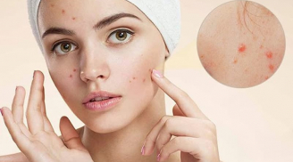 Chỉ trong 1 đêm bạn có thể làm sạch mụn trứng cá mà không mất tiền bằng 4 mẹo đơn giản sau