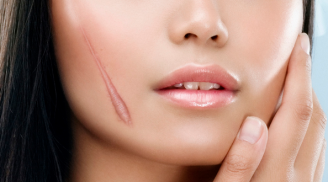 6 công thức làm mờ sẹo đơn giản dễ áp dụng giúp nàng lấy lại sự tự tin