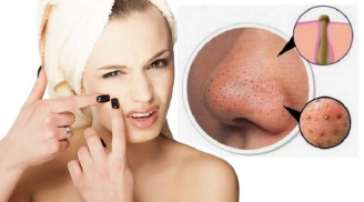 6 điều cần chú ý khi trị mụn đầu đen tránh làm tổn thương da mặt