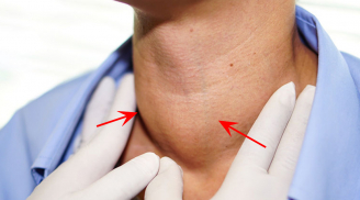 BS cảnh báo 3 tín hiệu lạ ở cổ coi chừng K tuyến giáp: Đừng dại chủ quan