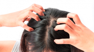 5 công thức làm sạch da đầu giảm tình trạng gàu rụng lả tả, tóc bết dầu