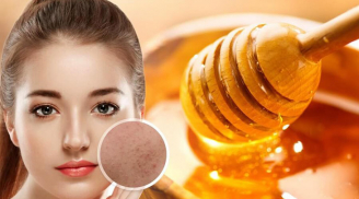 4 cách đánh bay mụn, giúp da trắng sáng mịn màng từ mật ong