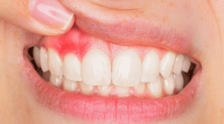 Thường xuyên chảy máu chân răng: Cảnh báo 4 căn bệnh nguy hiểm đừng chủ quan