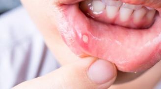 9 cách chữa nhiệt miệng tại nhà hiệu quả, không cần dùng đến thuốc