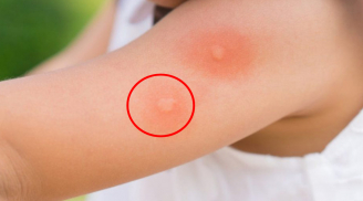 Mẹo giảm ngứa tức thì khi bị muỗi đốt, an toàn với cả trẻ nhỏ