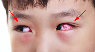 Đau mắt đỏ đang hoành hành, vậy nhìn vào mắt người bệnh có bị lây không?