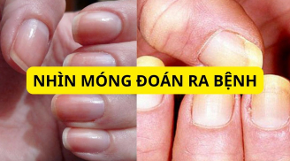 Móng tay xuất hiện dấu hiệu này chứng tỏ bạn đang bị bệnh, cần đi khám ngay