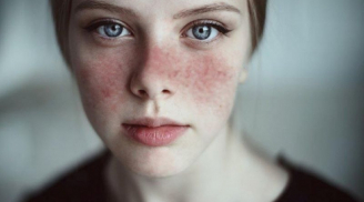 4 kiểu tổn thương da thường gặp phải và cách khắc phục đơn giản