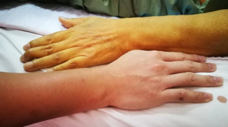 Người có gan khỏe sẽ không có 3 dấu hiệu này ở bàn tay: Kiểm tra xem bạn có không