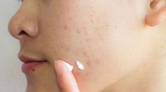9 công thức đơn giản chăm sóc làn da bị thâm, giảm sẹo mụn hiệu quả