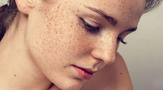 4 liệu pháp để loại bỏ nám da hữu hiệu nhất hiện nay