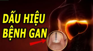 Móng tay có đường sọc đen: Gan đang chuyển biến nặng, gặp bác sĩ ngay