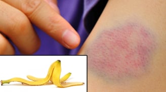 Bất ngờ với 6 mẹo hữu ích của vỏ chuối đối với sức khỏe và đời sống