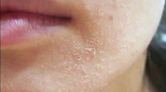 4 dấu hiệu cho thấy làn da của bạn đang trong tình trạng khẩn cấp, cần khắc phục ngay