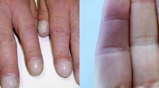 2 dấu hiệu nhỏ trên ngón tay tiết lộ bệnh nguy hiểm