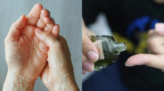 6 cách gỡ keo 502 dính tay đơn giản, hiệu quả tại nhà