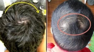 Nhìn xoáy tóc đoán tính cách và vận mệnh của một người