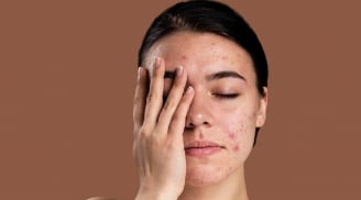 Điểm danh những thành phần cơ bản gây hại mà làn da nhạy cảm nên tránh xa