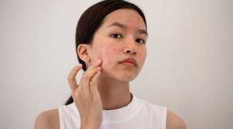 6 'thủ phạm' chính gây ra mụn khiến da mặt ngày càng xấu