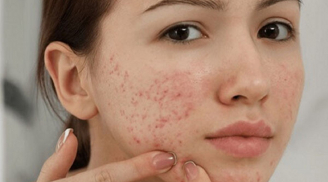 8 nguyên nhân gây mụn trứng cá