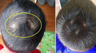 Các cụ nói: ‘Một xoáy sống lâu, hai xoáy trọc đầu, ba xoáy chết yểu, 4 xoáy làm quan’, có đúng không?