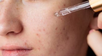 Da mụn dùng retinol như thế nào?