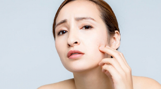 6 cách phòng mụn giảm bớt mụn ngày Tết nàng nên tham khảo