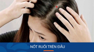 4 nốt ruồi vượng quý nhân, hậu vận giàu có vượt bậc