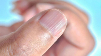 Tại sao móng tay có sọc thẳng đứng? 4 dấu hiệu bất thường cảnh báo vấn đề sức khỏe