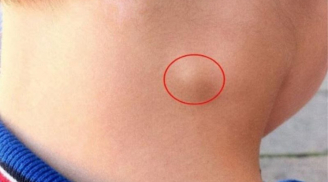 5 dấu hiệu ung thư hạch giai đoạn sớm, số 1 biểu hiện rất rõ ràng