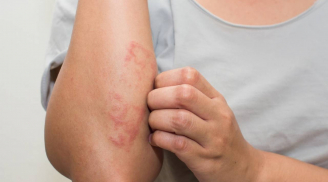 Cảnh báo: Những triệu chứng âm thầm của ung thư máu nhiều người hay bỏ sót