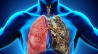 Cảnh báo: 8 dấu hiệu rõ ràng của ung thư phổi, đừng để tới khi di căn mới biết