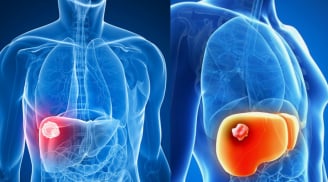 5 nhóm người có nguy cơ cao bị ung thư gan, nên đi tầm soát càng sớm càng tốt
