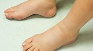 5 dấu hiệu cảnh báo bệnh thận đã đi vào giai đoạn nặng: Dù chỉ có 1 cũng nên đi khám gấp