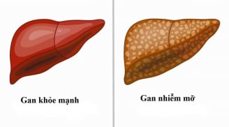 Gan nhiễm mỡ có gây ung thư gan? Chuyên gia cảnh báo dấu hiệu cần biết sớm