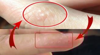 Tay  mọc mụn nước li ti có sao không?