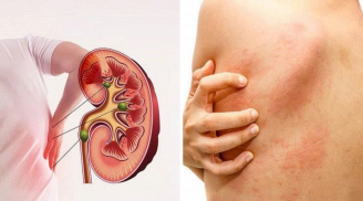 5 dấu hiệu suy thận giai đoạn đầu cần biết: Số 3 nhiều người bị nhưng phớt lờ