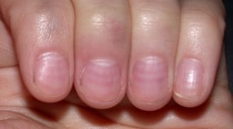 Nhìn móng tay bắt bệnh cực kỳ chính xác