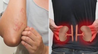 Cơ thể có 7 dấu hiệu này, cảnh báo bệnh thận, suy thận đang đến gần