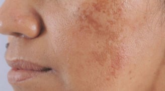 Bạn bị đốm đồi mồi, tàn nhang thường là do 3 điều này, hãy chủ ý đển chúng để có làn da đẹp